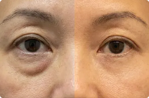 Customer using MyoGlow device