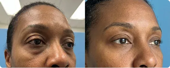 Customer using MyoGlow device